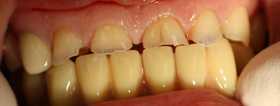 demineralizare dinti