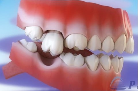 demineralizare dinti